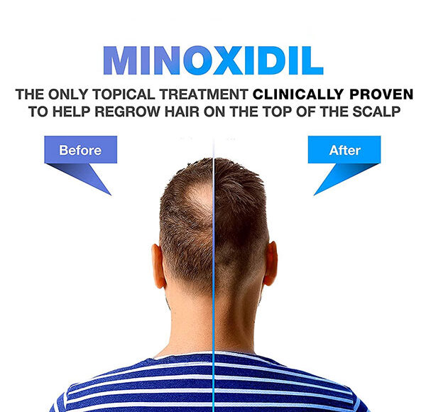Minoxidil (Topical Route) Best for hair